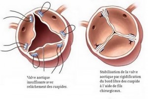 chirurgie vasculaire Tunisie