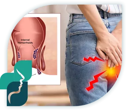 Chirurgie hemorroides Tunisie - types d'affection anales