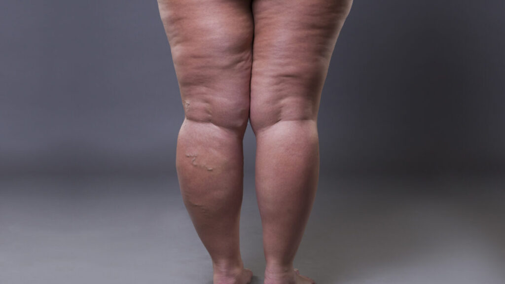 لليبوليـمفوديما في تونس